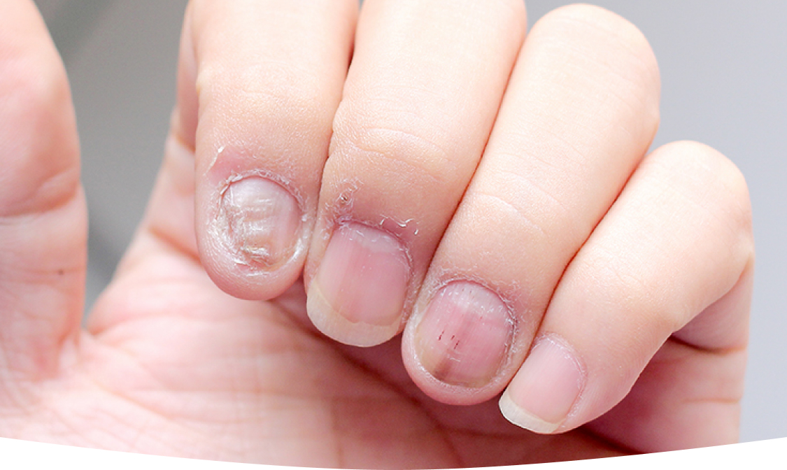 The Most Common Causes of Nail Fungus